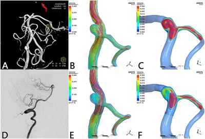 Patency of Posterior Circulation Branches Covered by Flow Diverter Device: A Hemodynamic Study